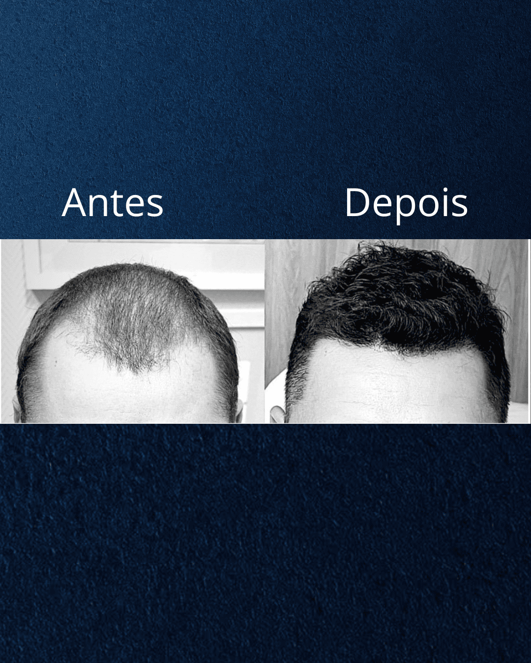 Capelli Primi Transplante Capilar em Florianópolis — foto 2