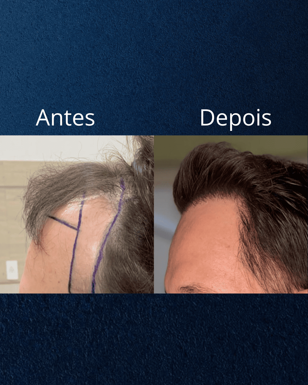 Capelli Primi Transplante Capilar em Florianópolis — foto 3