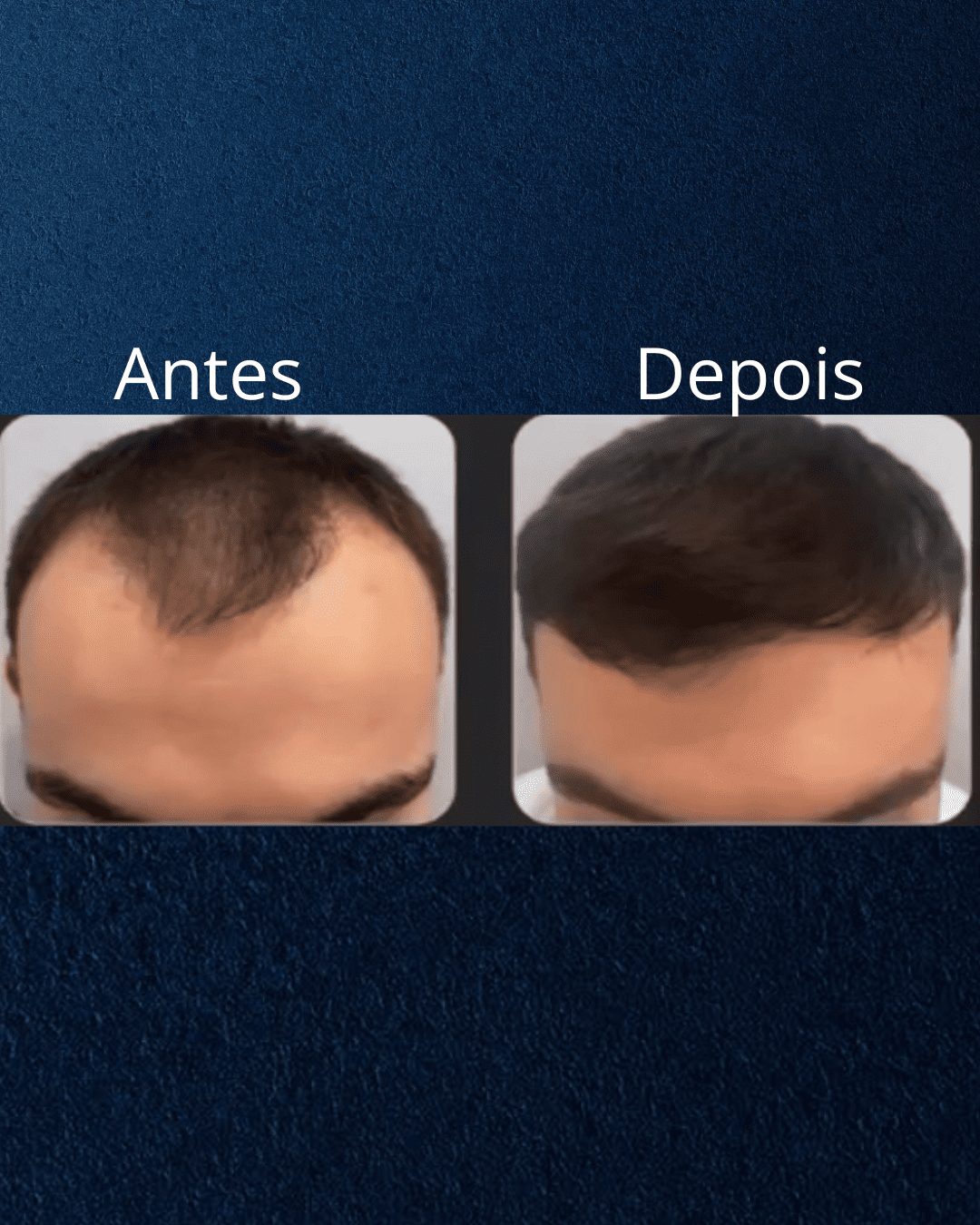 Capelli Primi Transplante Capilar em Florianópolis — foto 4