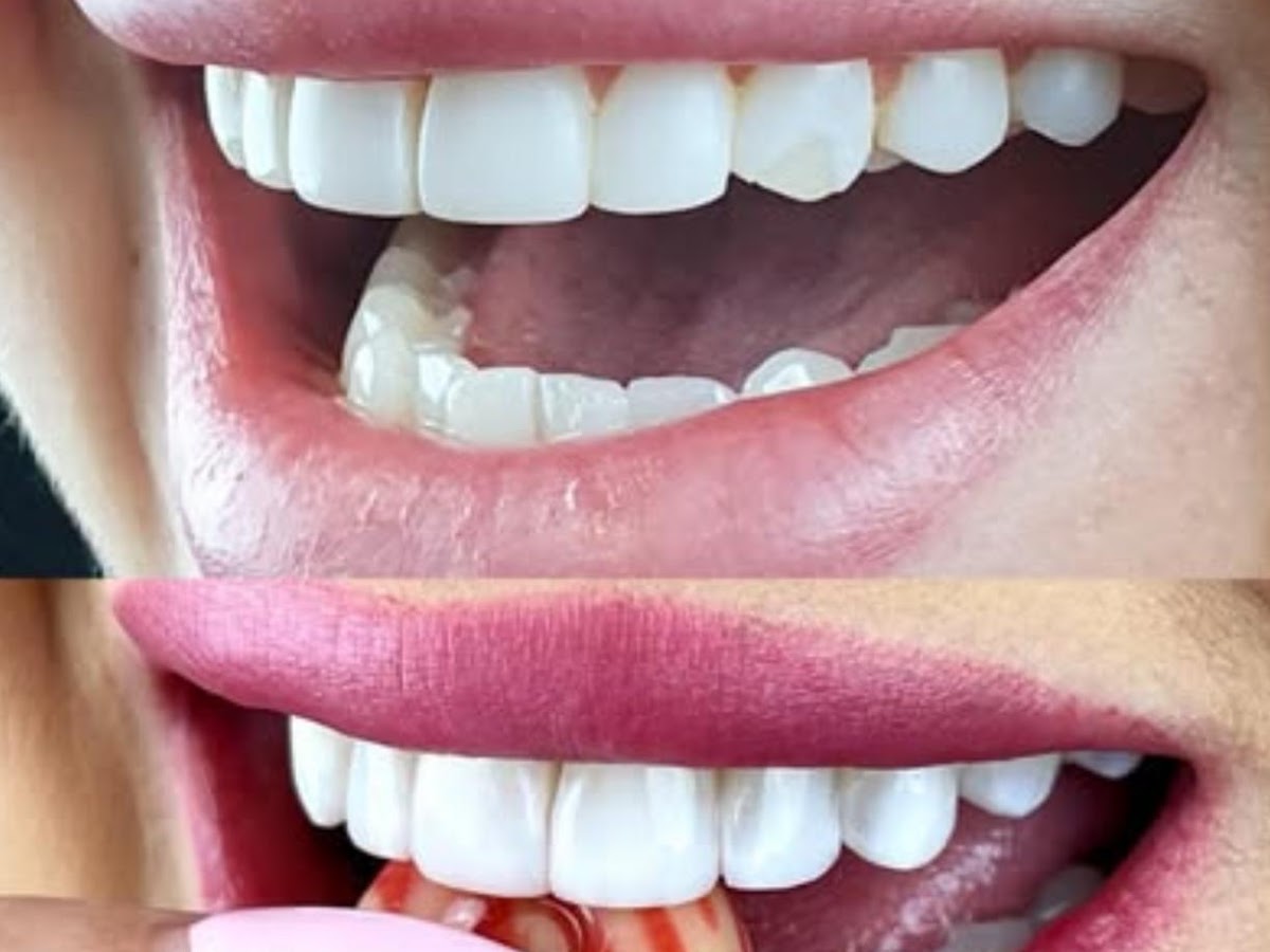 Dentista em Florianópolis - Dra Michelini Cherem | Implantes - Próteses | Harmonização Facial - Ortodontia- Lentes de Contato em Florianópolis — foto 3