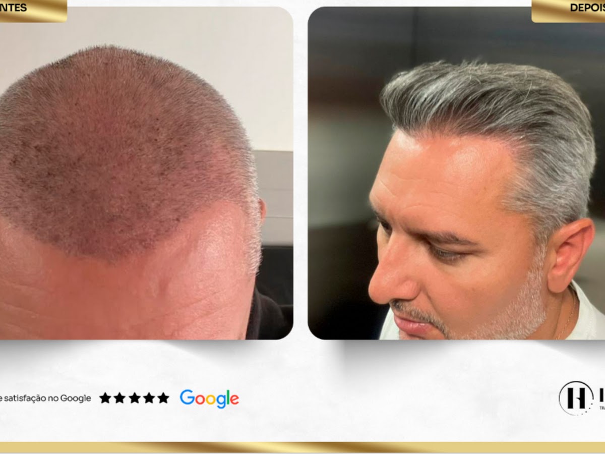 Foto da Hairzy - Transplante Capilar de Alta Densidade